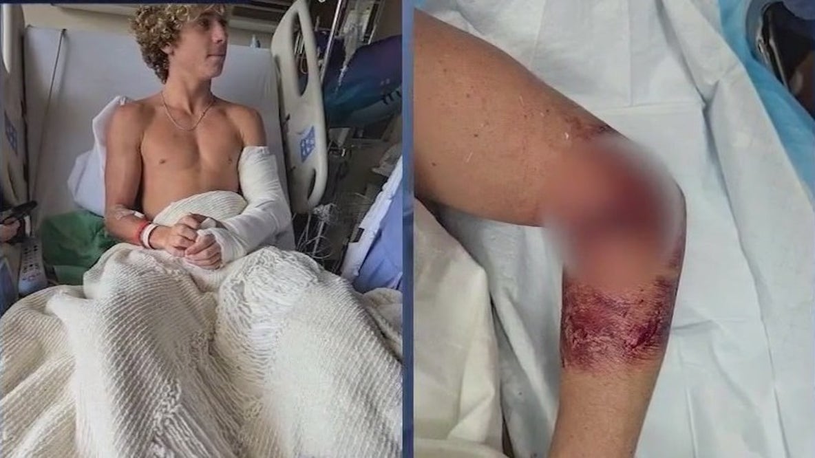 Teen surfer survives shark attack in Florida